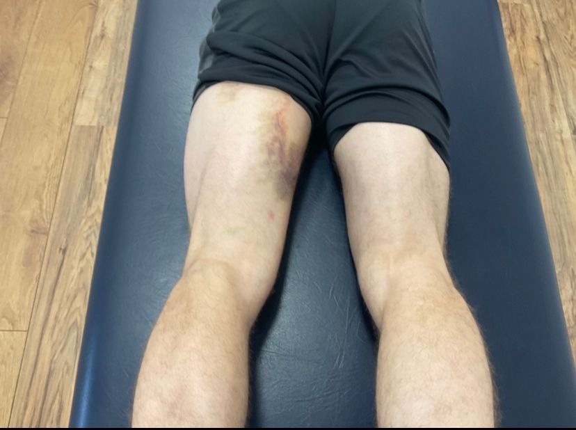 Hamstring injuries: When should you see a physio?