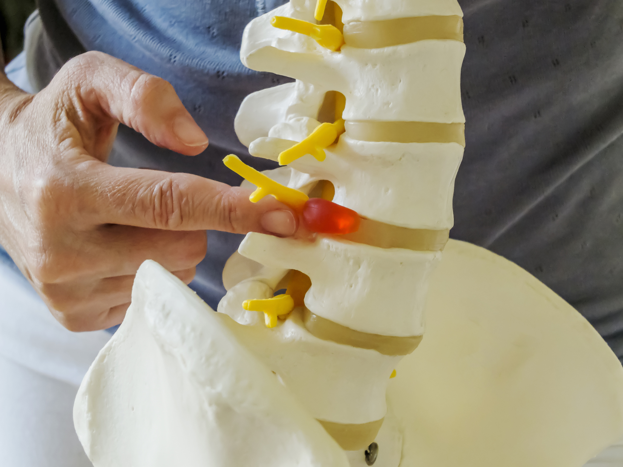 What is sciatica?