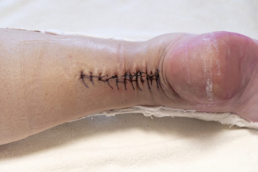 What is an achilles rupture?