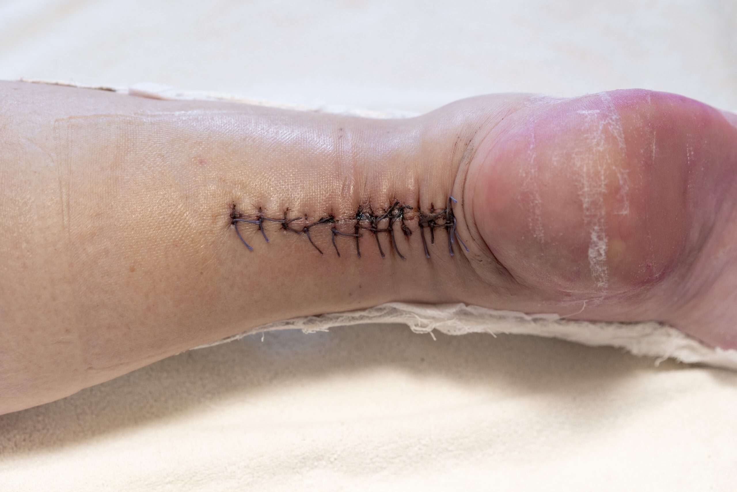 What Is An Achilles Rupture?