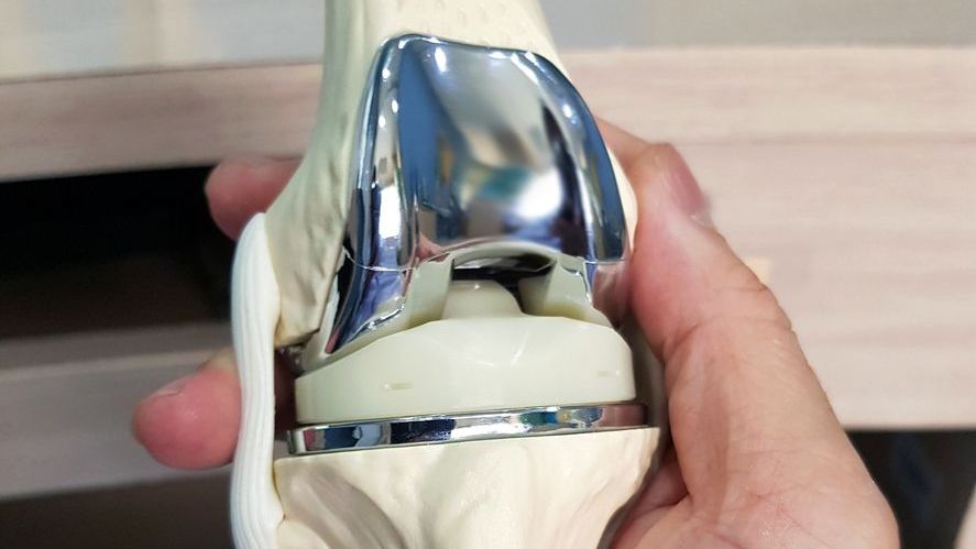 Could Mako Robotic Joint Replacement Be the Key to Your Pain-Free Future?