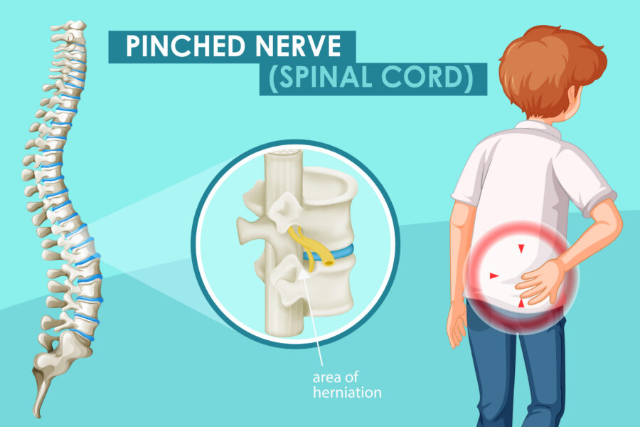 sciatica pinched nerve